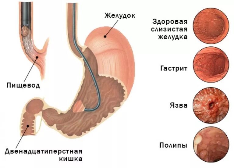 Можно ли есть кишки. Язвенная болезнь желудка ФГДС. Двенадцатиперстная кишка ФГДС. ФГДС при язвенной болезни желудка.