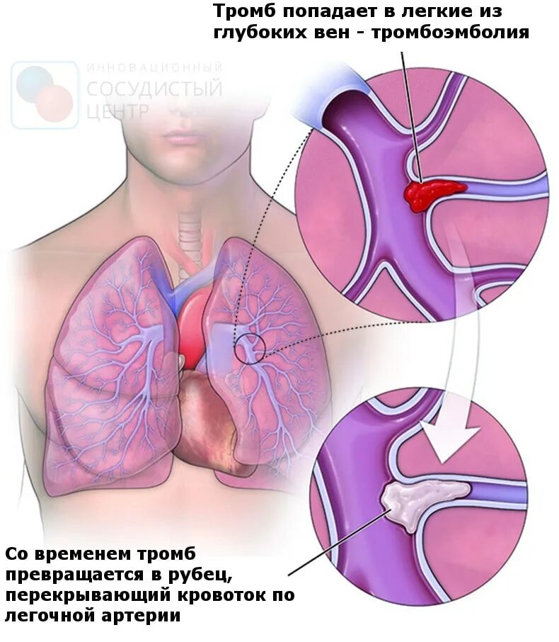 Легочная тромбоэмболия прогноз. Тромбоэмболия ветвей легочной артерии. Эмболия тромбом легочной артерии (Тэла);. Тромбоэмболия крупных ветвей легочной артерии. Тромбоэмболия ветвей легочной артерии симптомы.