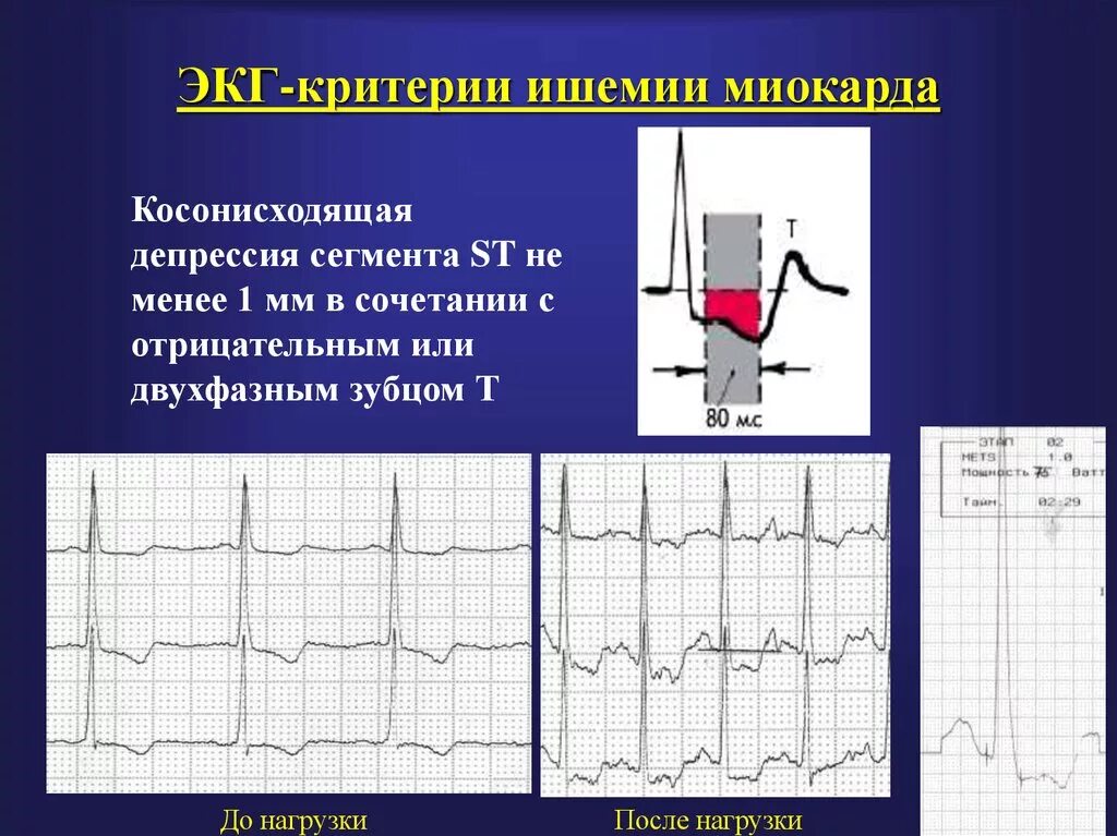 Депрессия сегмента st. Депрессия сегмента St на ЭКГ v5 v6. Безболевая ишемия ЭКГ. ЭКГ при безболевой ишемии миокарда. Косонисходящий сегмент St на ЭКГ.