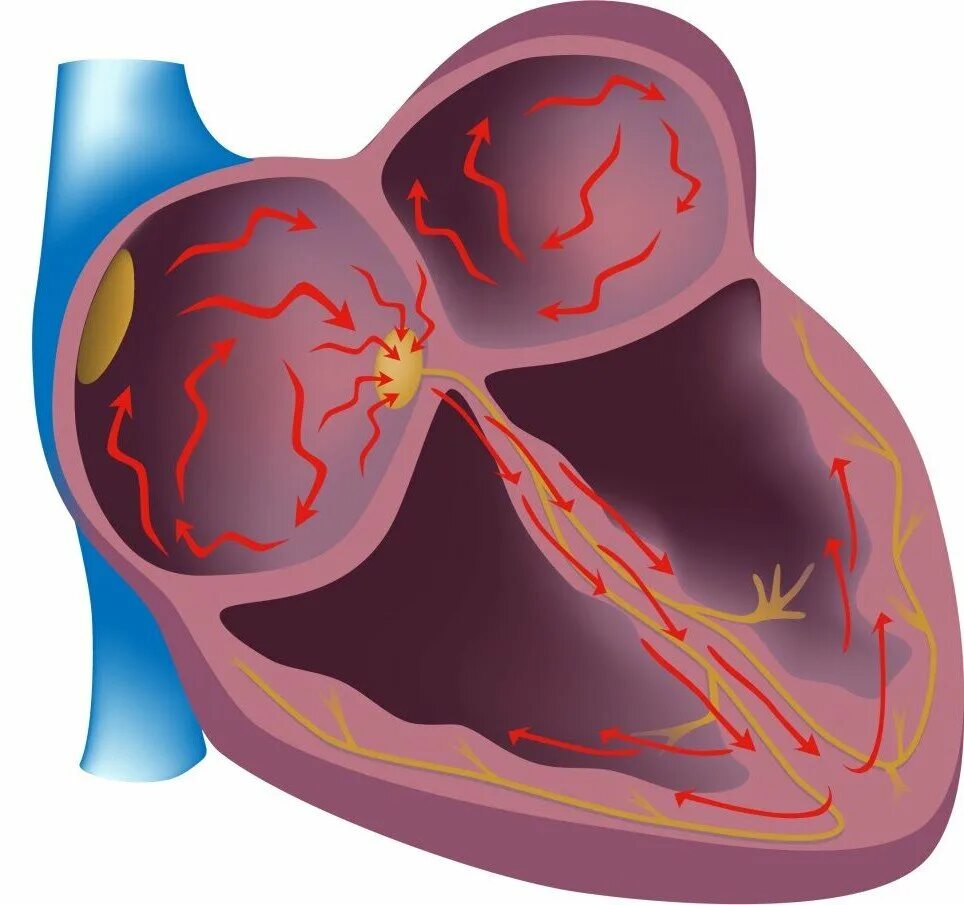 Рча предсердий. Катетерная абляция сердца что это такое. Катетерная аблация фибриляции предсердий. Радиочастотная аблация аритмий сердца.