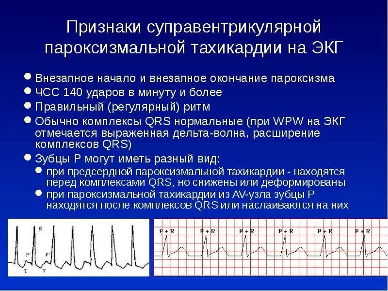 Пароксизм это простыми словами. Суправентрикулярная тахикардия (свт) ЭКГ. Пароксизмальная наджелудочковая тахикардия ЭКГ. Критерии наджелудочковой пароксизмальной тахикардии на ЭКГ. Наджелужочкова ятахикаржия на ЭКГ.