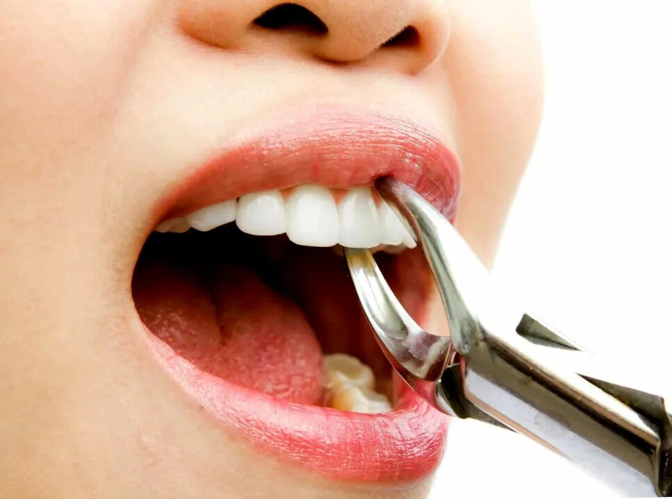 Сколько стоит снимать зуб. Кейсы стоматология.