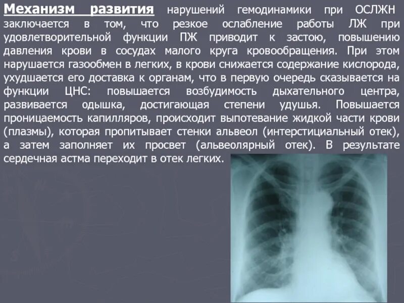 Отёк лёгких рентген описание. Альвеолярный ОТК легкого рентген. Отек легких рентген описание. Отек легких на рентгенограмме. Бронхиальная астма отек легких