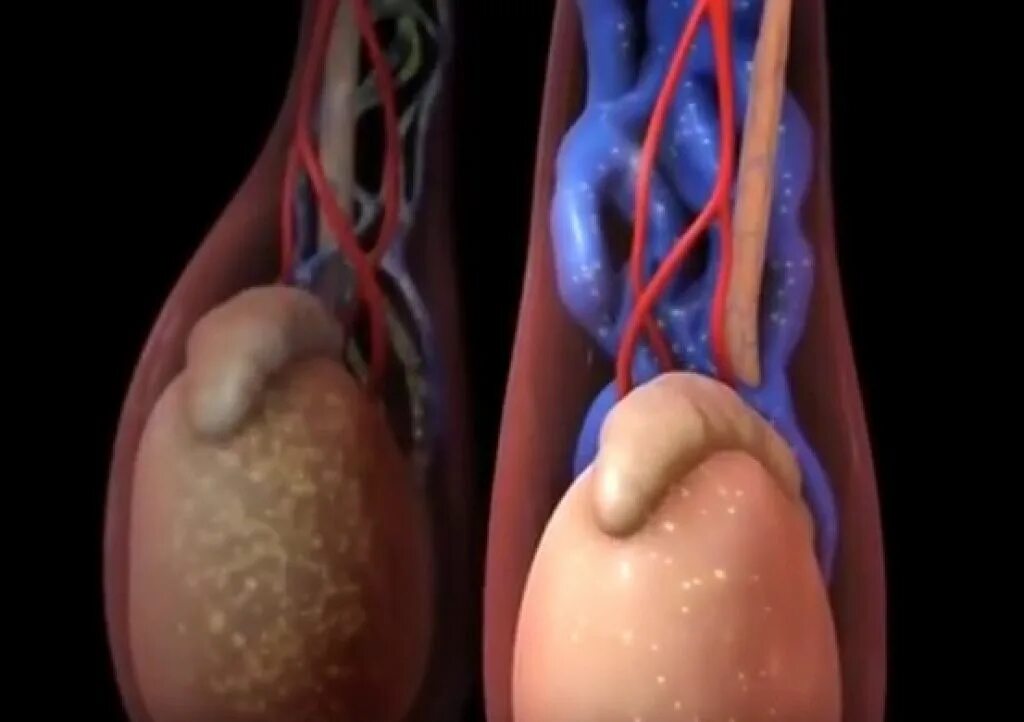 Холодные яйца у мужчины. Варикоз вен семенного канатика. Варикозное расширение вен семенного канатика яичка.. Варикозное расширение вен семенного канатика III степени. Варикозное расширение вен машонка.