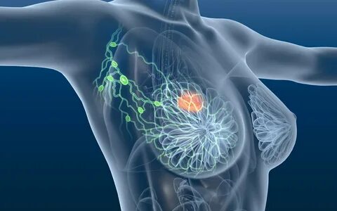 Tiên lượng và phòng ngừa ung thư biểu mô tuyến vú dạng nhầy.