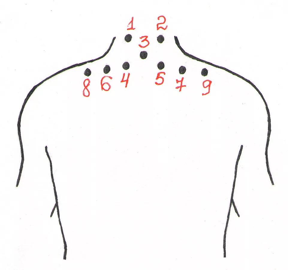 Банки при болях в спине. Схема постановки пиявок шейный остеохондроз. Гирудотерапия схема постановки пиявок. Схема постановки пиявок при остеохондрозе шейного отдела.