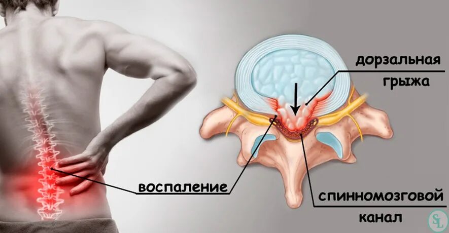 Дорзальная протрузия диска что это такое. Диффузная дорзальная грыжа межпозвонкового диска l4-l5. дорзальная медианная грыжа l3l4. дорзальная протрузия межпозвоночного диска. дорзальная-циркулярная грыжа диска.