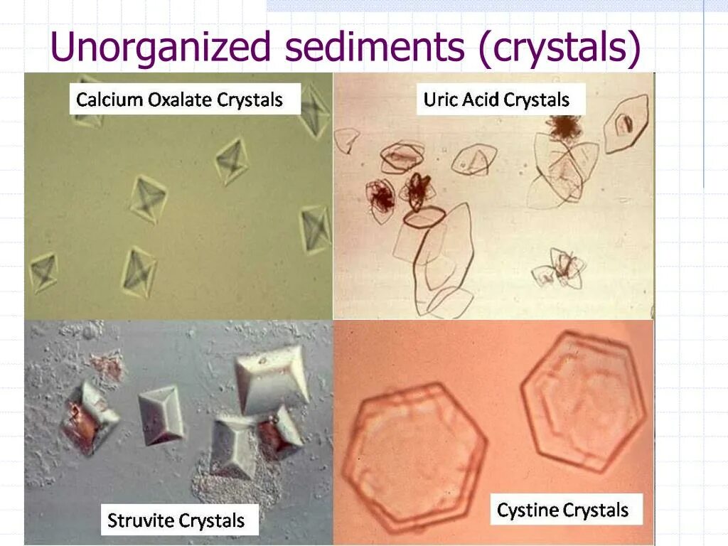 Растворение струвитов. Камни струвиты и оксалаты. Струвиты микроскопия. Струвиты и оксалаты под микроскопом. Струвиты и оксалаты микроскопия.