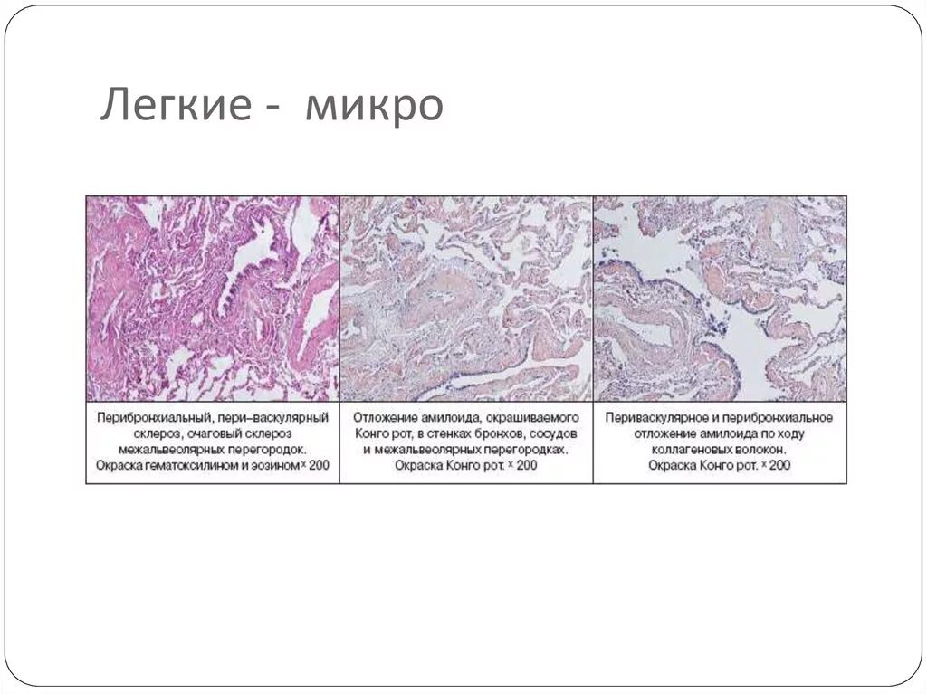 Основы микро. Хронический бронхит микро. Легкое в норме микропрепарат.