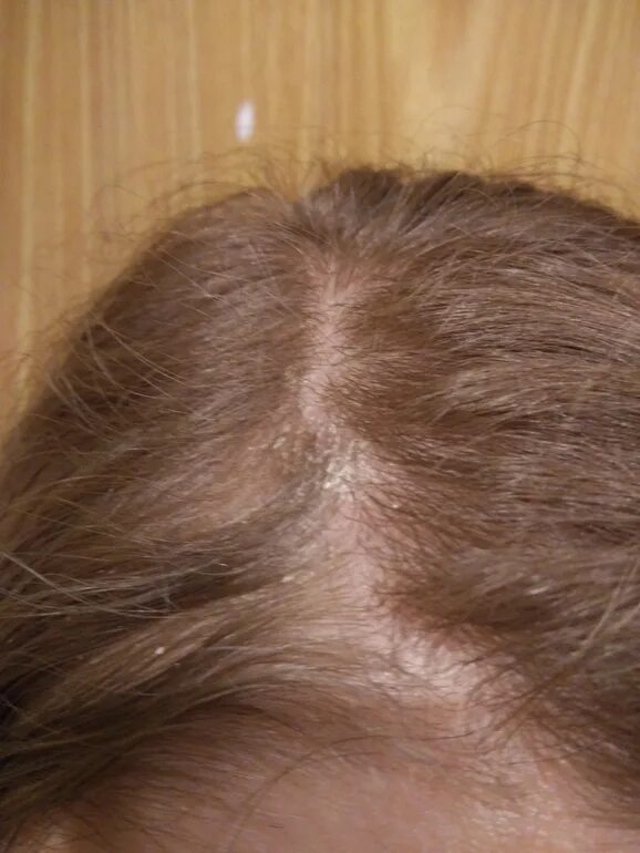 Шампунь от перхоти. Шелушится кожа головы шампунь. Шампунь от себореи кетоконазол. Гель от себореи на голове. Лечебный шампунь.