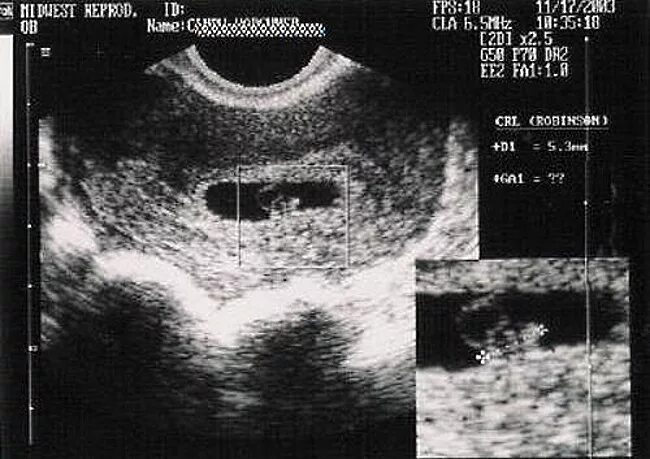 6 Эмбриональных недель беременности УЗИ. УЗИ 5-6 недель беременности сердцебиение. 6 Акушерских недель беременности на УЗИ. Акушерский срок 6 недель