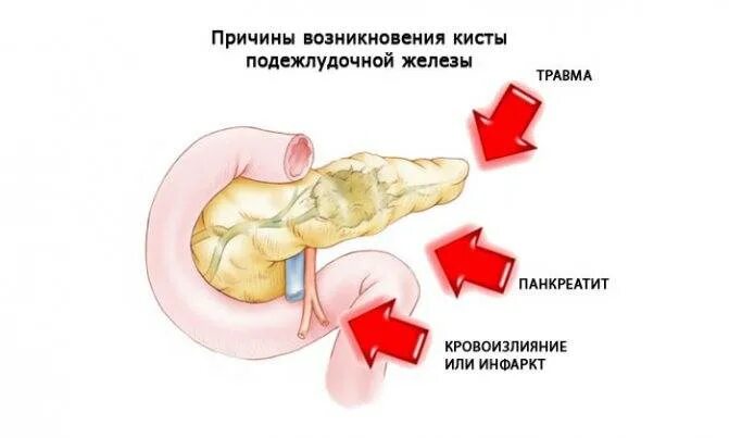 Паразитарная киста печени. Паразитарные заболевания печени. Паразитарная киста печени. Непаразитарные кисты печени классификация. Патогенез радикулярной кисты.