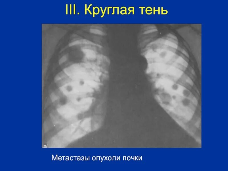 Метастазирование опухоли почки. Метастазы опухоли почки. Округлые тени в легких.