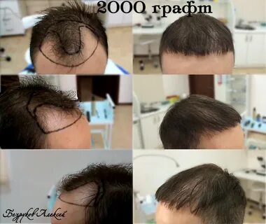Сколько растут волосы после пересадки