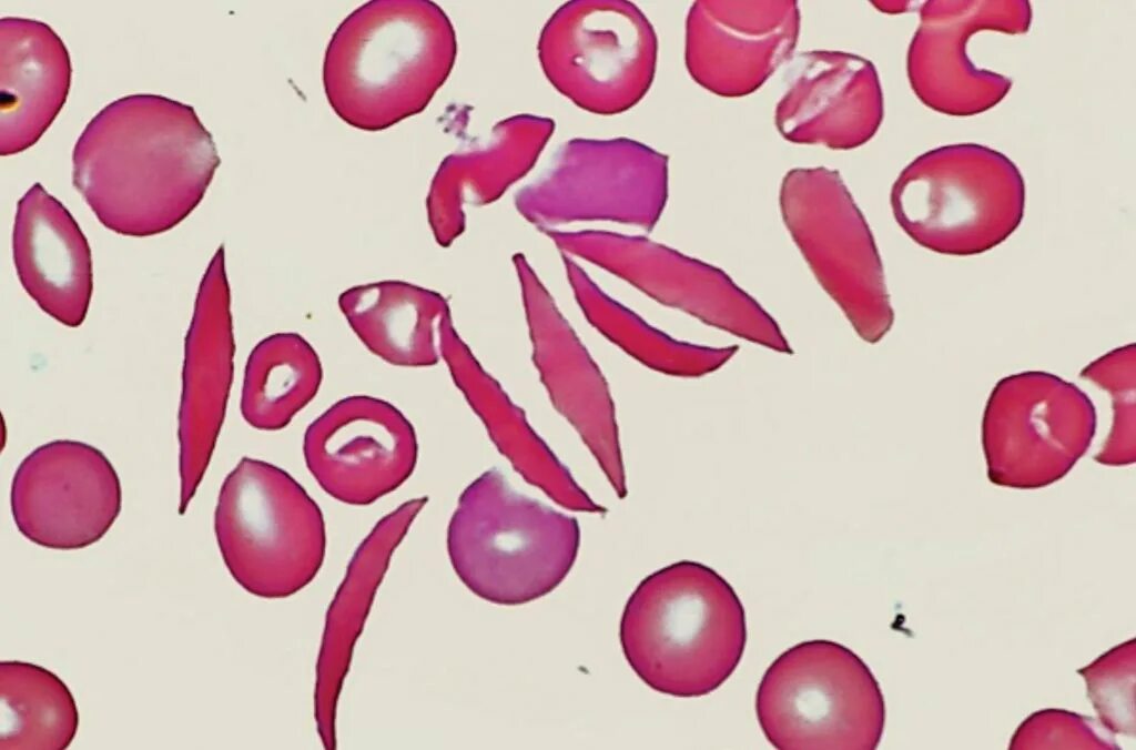 Эритроциты при серповидно клеточной анемии. Серповидноклеточная анемия микроскопия. Серповидноклеточная анемия эритроциты. Серповидноклеточная анемия мазок. Серповидноклеточная анемия мазок крови.