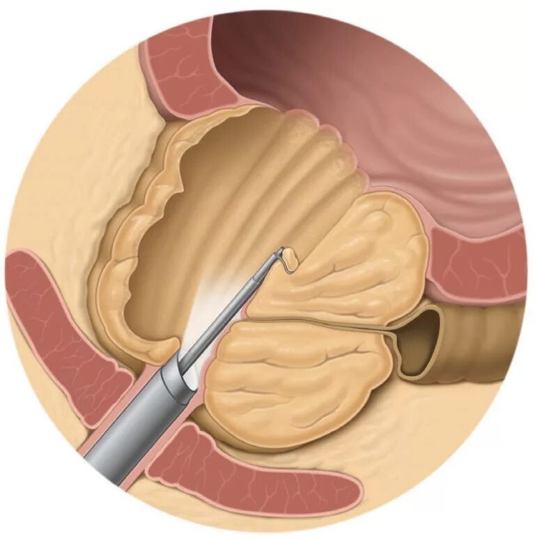 Простата у человека. Трансуретральная аденомэктомия. Трансуретральная резекция аденомы. Трансуретральная резекция предстательной железы. Тур трансуретральная резекция простаты.