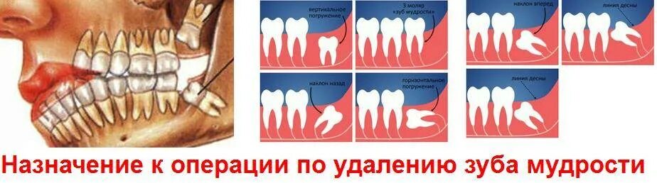 Лечение зуба 8. Вырезание зуба мудрости.