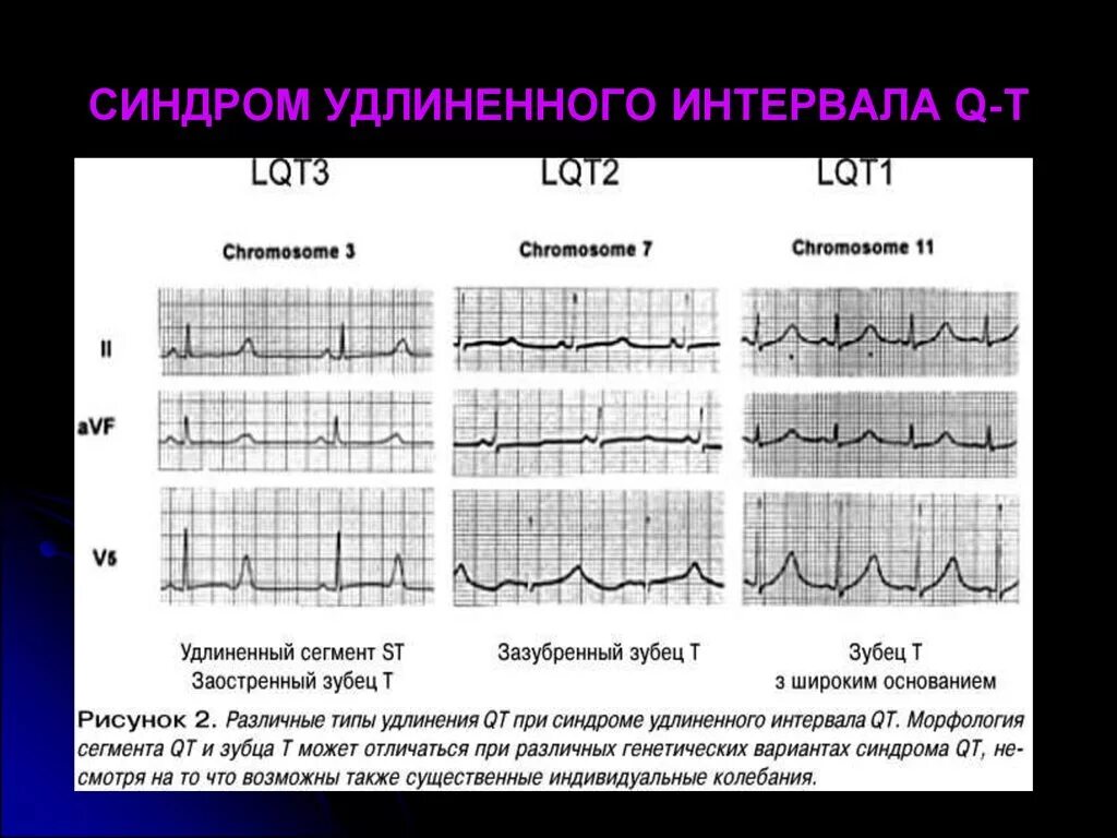 Удлиненное qt у ребенка