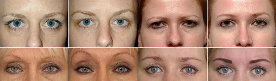 ботокс и птоз верхнего века. ботокс для бровей. опускание бровей после ботокса. птоз века после ботокса. ботулотоксин брови мефистофеля.