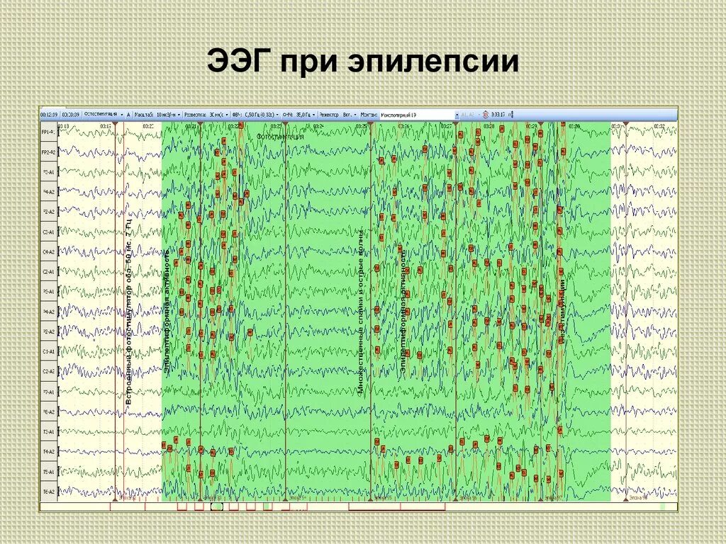 Ээг при эпилепсии. Патологические ритмы ээг при эпилепсии. ээг больного эпилепсией. ээг здорового человека и эпилептика. ээг при эпилепсии расшифровка у детей.