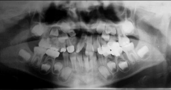 Аномалии удаления. Сверхкомплектные зубы аномалия. Полиодонтия (сверхкомплектные зубы). Сверхкомплектные зубы рентген.