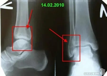 Перелом лодыжки сколько заживает