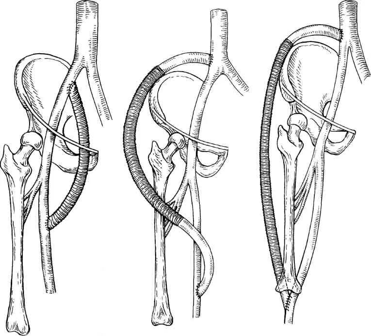 Бедренно-подколенное шунтирование. Бифуркационное аорто-бедренное шунтирование. Аортобифеморальное шунтирование. Аорто подвздошно бедренное шунтирование.