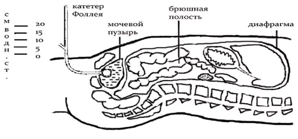 Перитонеальный катетер для диализа. Перитонеальный диализ брюшина. Катетер в брюшной полости. Брюшная полость перитонеальный диализ. Перитонеальный лаваж.