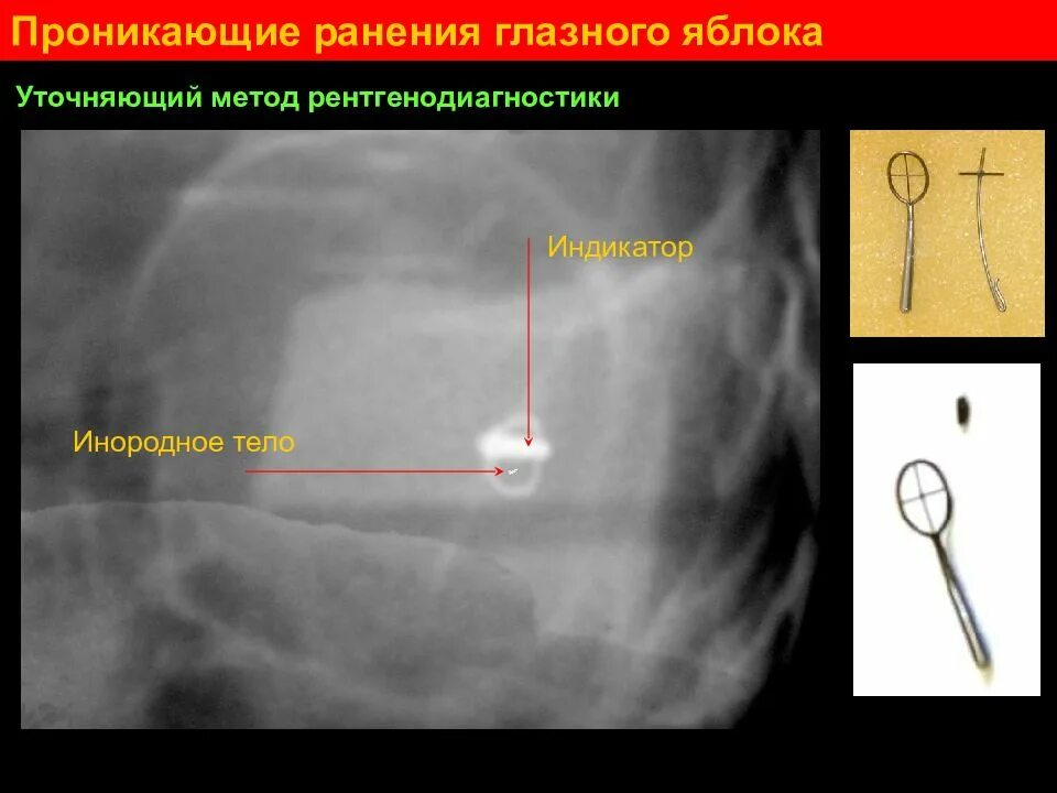 Реакция инородного тела