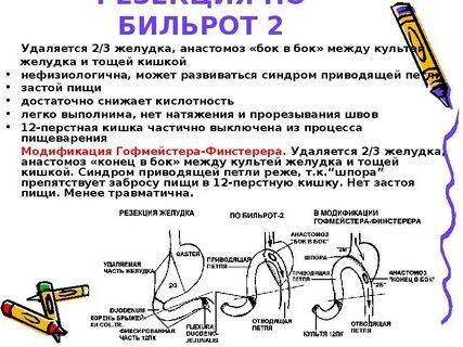 Резекция желудка по бильрот 1