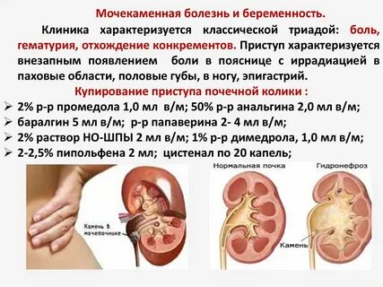 Почечная колика у беременных