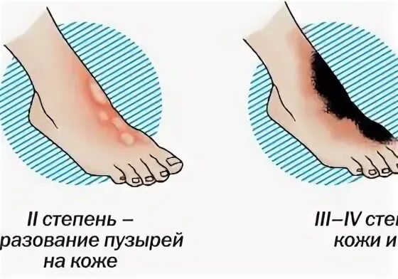 Холодная травма