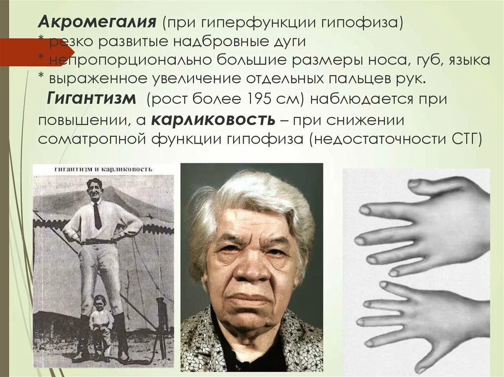 Гиперфункция гипофиза акромегалия. Акромегалия и гипофизарный гигантизм. Карликовость гигантизм акромегалия. Акромегалия пропедевтика внутренних болезней. Нарушения работы гипофиза заболевания