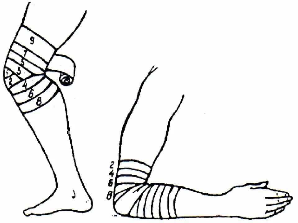 Эластичное бинтование ноги. Бинтование конечностей эластическим бинтом. Бинтование верхней конечности. Компрессионное бинтование нижних конечностей. Бинтование колена бинтом.