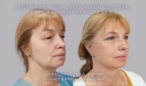 Круговая подтяжка лица в нижнем новгороде