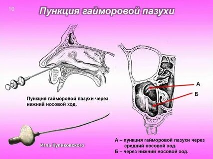 После пункции что делать