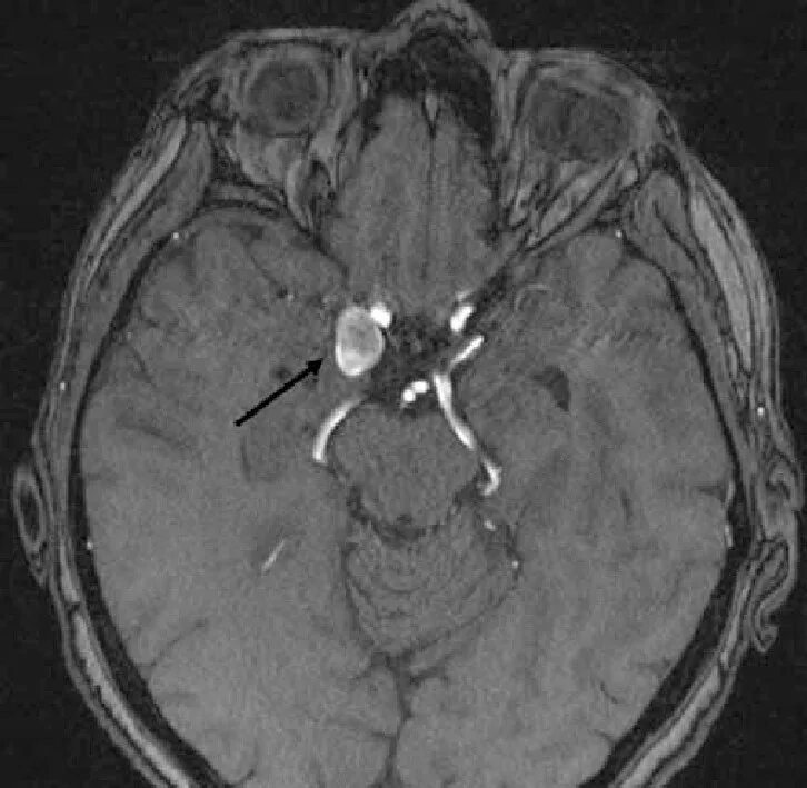 Форум аневризма мозга. Кт ангиография аневризма головного мозга. Сосуды головы кт аневризма. Аневризма головного мозга на кт.