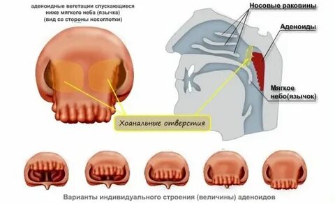 Степени аденоидита у детей