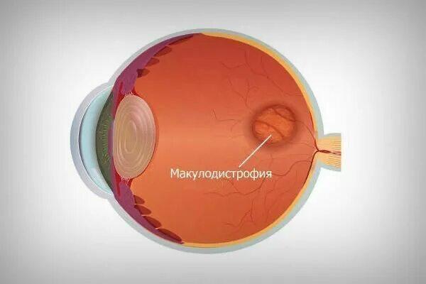Возрастная макулодистрофия сетчатки. Влажная дистрофия. Макулодистрофия друзы. Макула дистрофия сетчатки. Макулодистрофия друзы.
