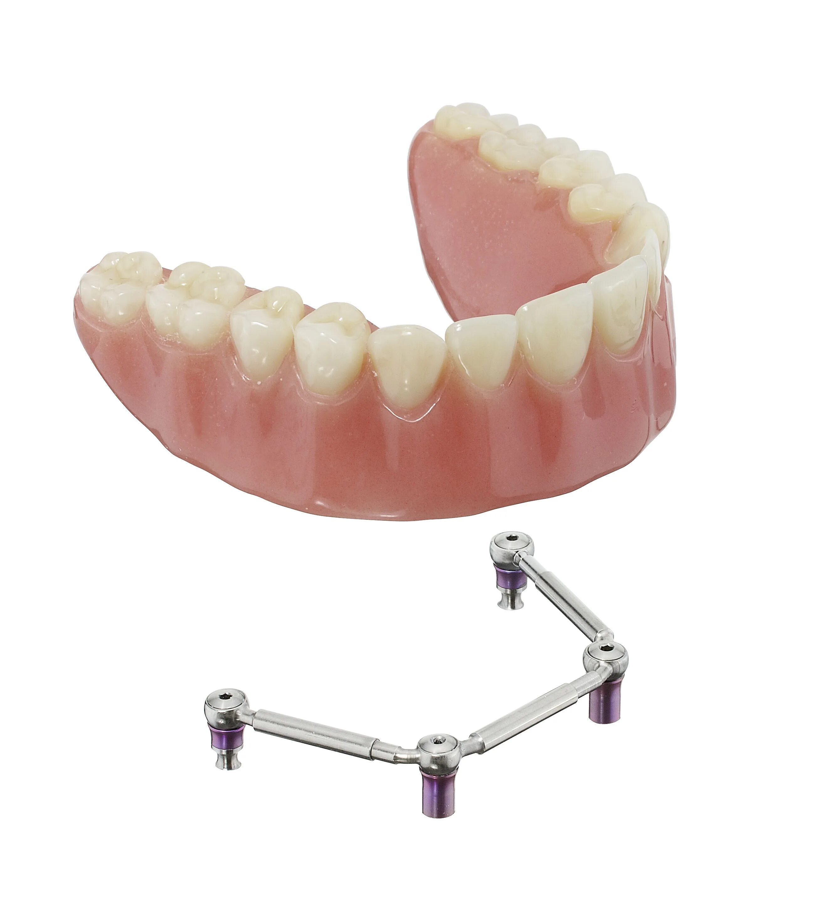 Телескопическая система фиксации бюгельных протезов. Телескопическая система фиксации на имплантаты. Телескопическая система крепления съемных протезов. Съемный протез с балочной системой фиксации. Как крепятся съемные