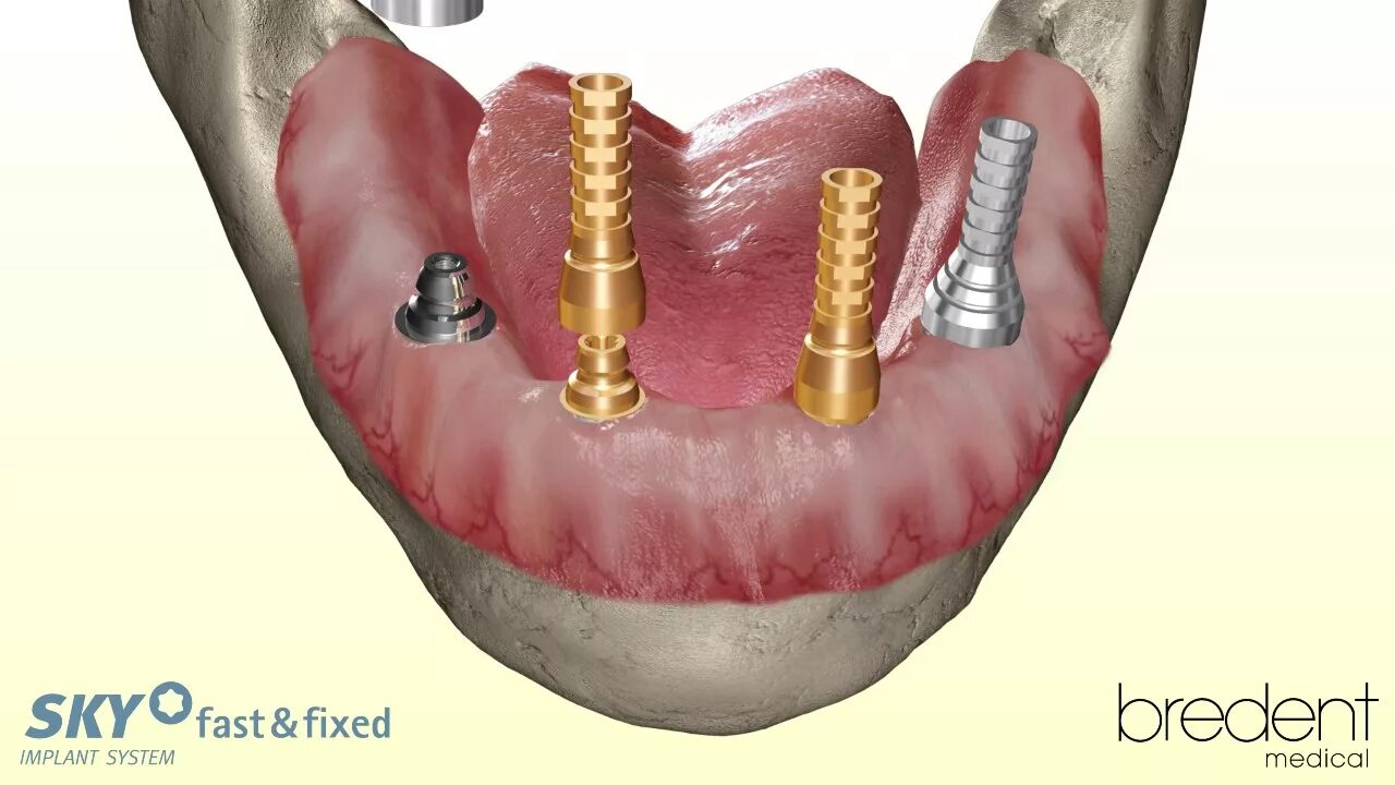 Sky Bredent. Bredent импланты. Импланты Sky. Имплант Bredent (Германия). Fixed 3d