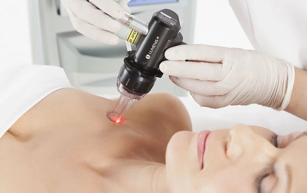 Лазерная шлифовка акция. Лазерная шлифовка со2 акне. Лазерный пилинг фраксель. Фраксель лазер шлифовка. Фракционный фототермолиз со2 лазером.