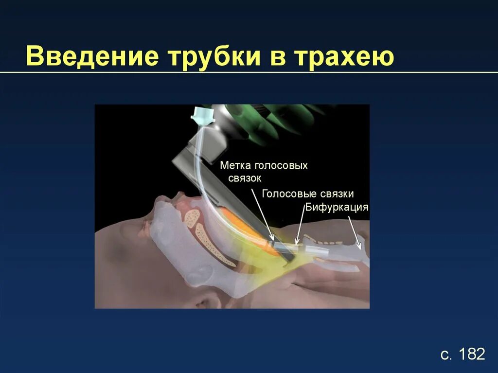 Трубка в трахею. Трахеостомия трубка дыхательная. Трахеостома трубка ивл. Трахеостома трубка наркоз. Санационная бронхоскопия.