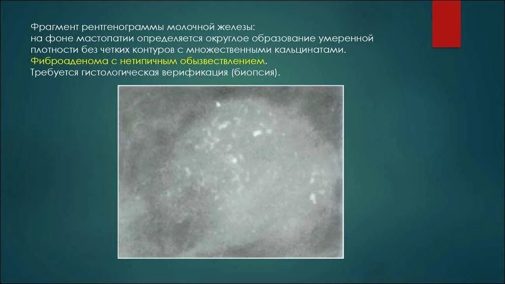 Что значит кальцинат в молочной железе. Доброкачественные кальцинаты молочных желез. протоковые кальцинаты молочных желез. микрокальцинаты молочной железы рентген. образование с микрокальцинатами в молочной железе.