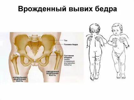 Норма тазобедренного сустава у новорожденных