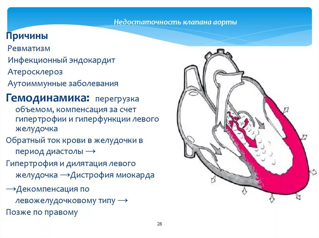 Сердечная недостаточность митрального клапана. Пороки сердца схема митральная недостаточность аортальная. Приобретённые пороки сердца недостаточность митрального клапана. Гемодинамика недостаточности клапана аорты включает. Недостаточность аортального клапана схема.