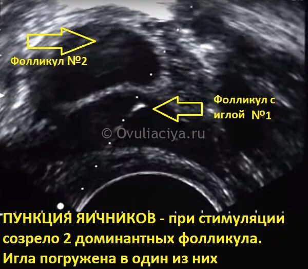 Состояние яичников после стимуляции овуляции. После овуляции есть доминантный фолликул. Доминантный фолликул 20 мм. Боли после пункции фолликулов