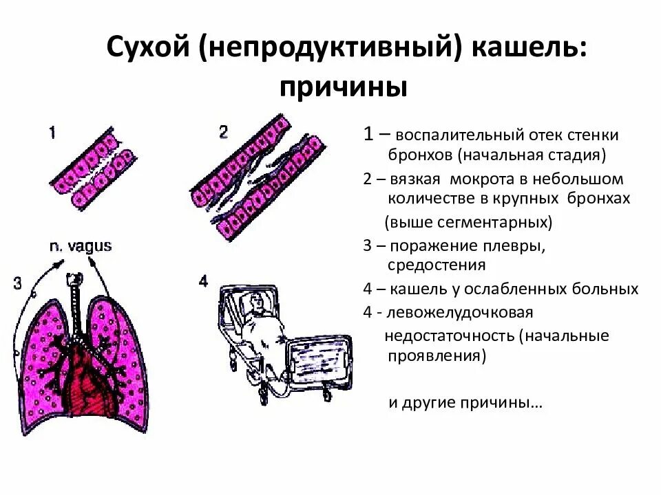 Сухой кашель длительное время причины у взрослого. Сухой непродуктивный кашель. Сухой непродуктивный кашель у ребенка. Сухой надсадный кашель. Сухой малопродуктивный кашель.