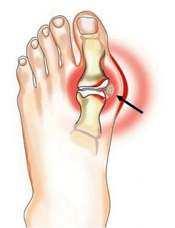 Причины болят пальцы на ногах почему. Гигрома плюснефалангового сустава. Подагра большого пальца ноги. Подагрический артрит большого пальца ноги. Падагоа большого ПАЛЬЦАМНА ноге.