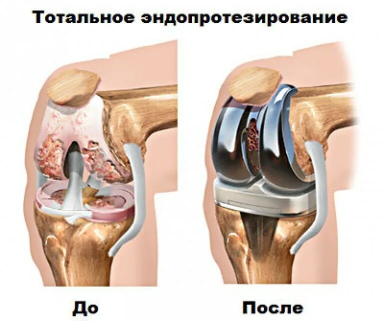 Эндопротез коленного сустава Stryker. Stryker протез коленного сустава. Тотальное эндопротезирование коленного сустава. Эндопротез коленного сустава операция. Эндопротезирование отзывы после операции